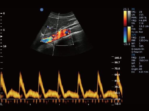 - Aorta Artery PW Mode Ebit50 Medical