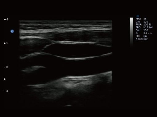 - CCA ICA ECA B Mode Ebit 50 Medical