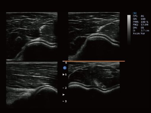 - Elbow Joint 4B Mode Ebit50 Medical