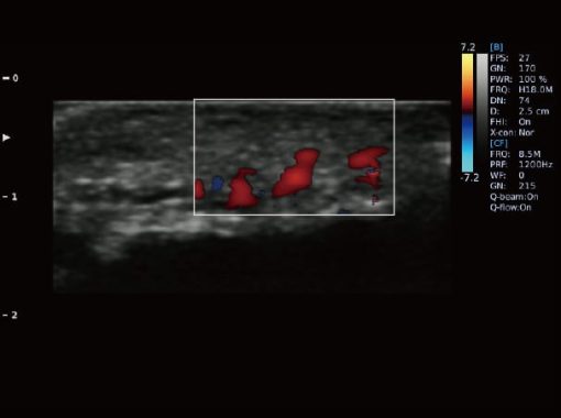 - Fingertips Vessle C Mode Ebit 50 Medical