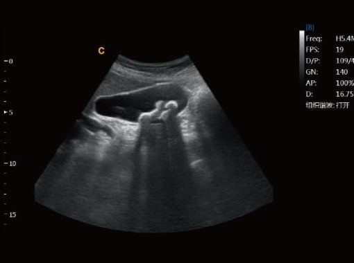 - Gallbladder stone，B Mode Ebit50 Medical