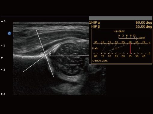 - HIP Graf Ebit50 Medical