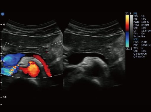 - Pancreas B.BC Mode Ebit50 Medical