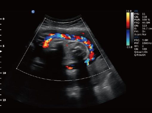 - Umbilical cord C Mode Ebit50 Medical