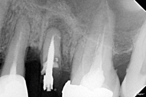 Acteon Sopix² Digital Dental Sensor - Image 2