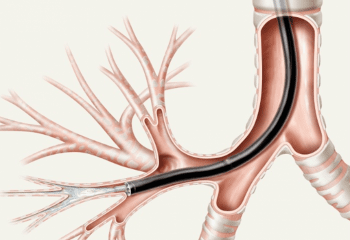 Aspiration Catheters - Range of Sizes - Sterile & Non-Sterile - Image 2
